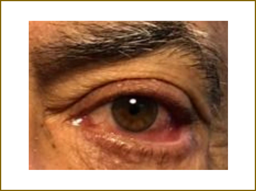 Cirurgia do Ectrópio