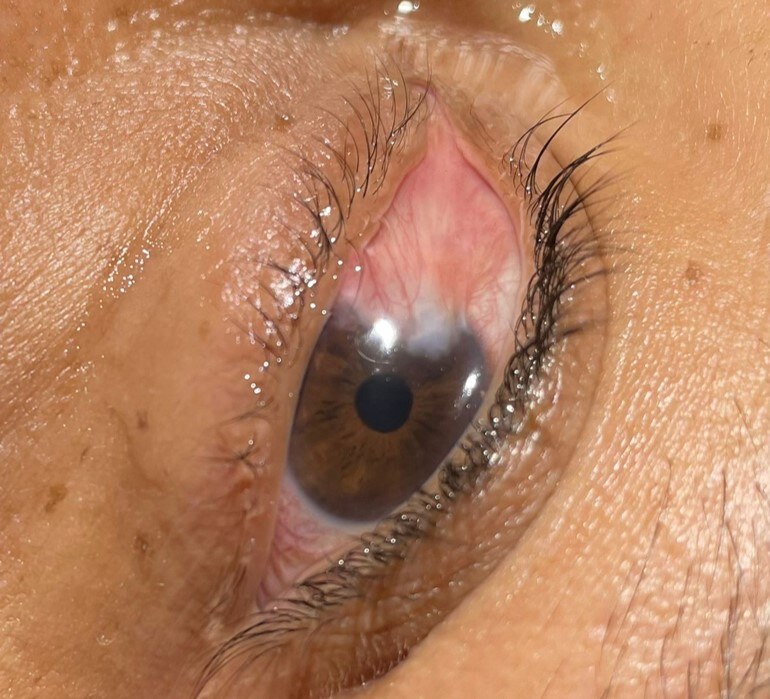 Pterígio com Transplante Conjuntival