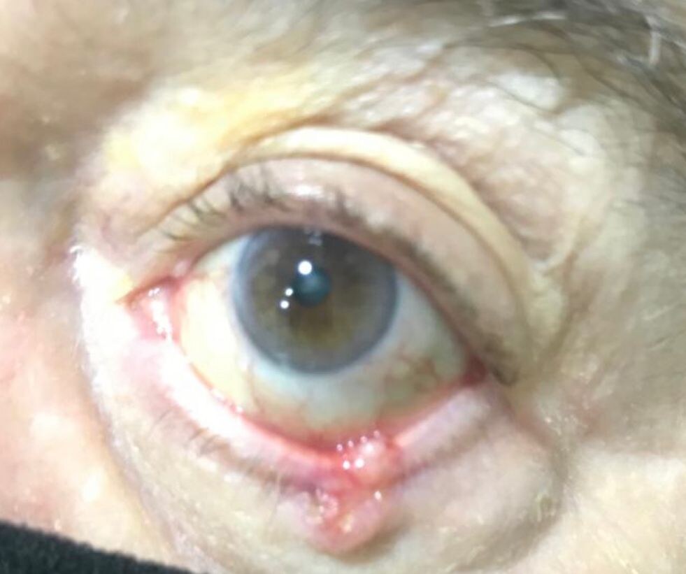 Cirurgia do Tumor Palpebral