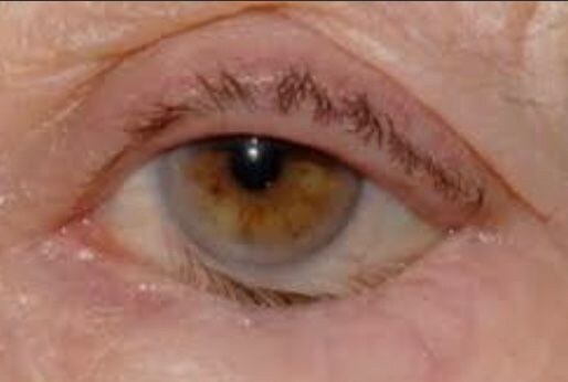 Cirurgia do Entrópio