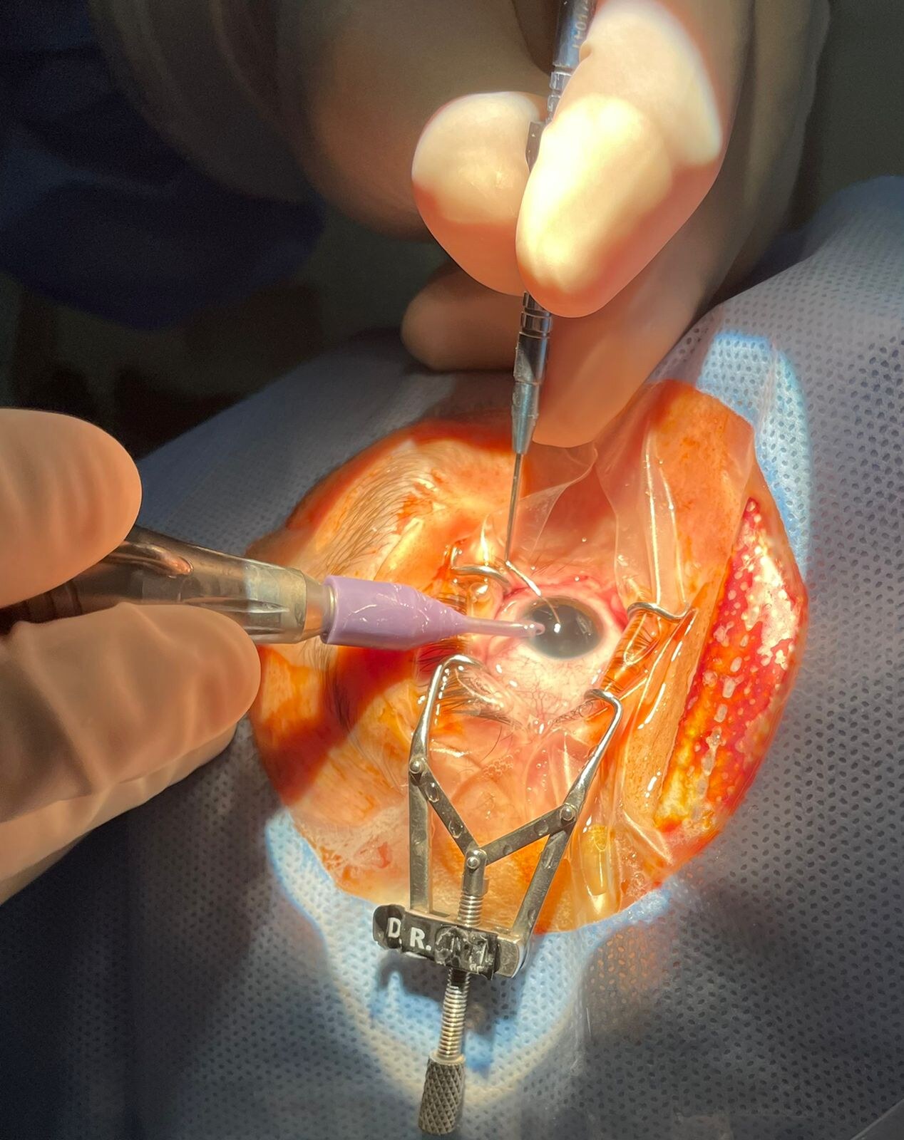 Cirurgia de Catarata Implante de Lente Intraocular