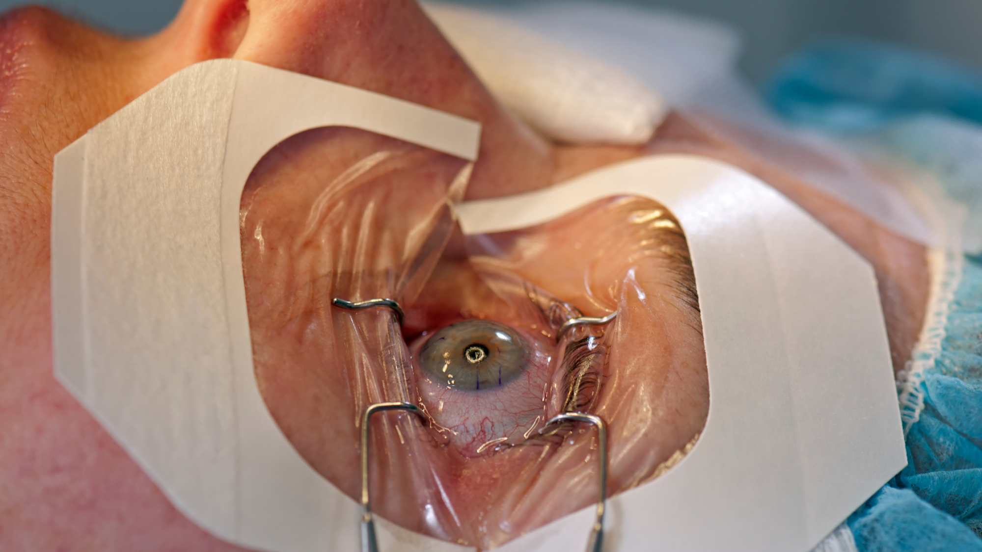 O que você precisa saber sobre transplante de córnea