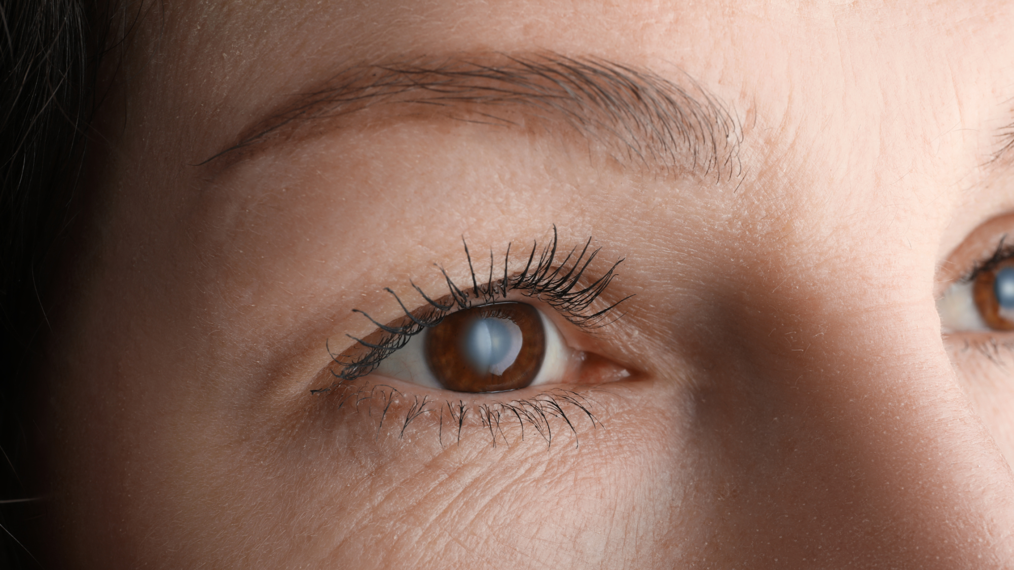 Quando suspeitar do glaucoma?